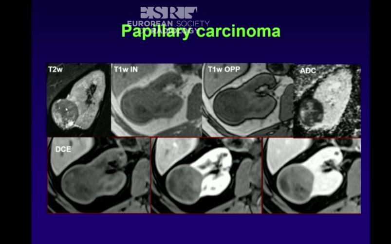 Θηλώδες RCC MRI Pap RCC êσήμα σε Τ2 και Τ1 êadc êαγγείωση και é στη