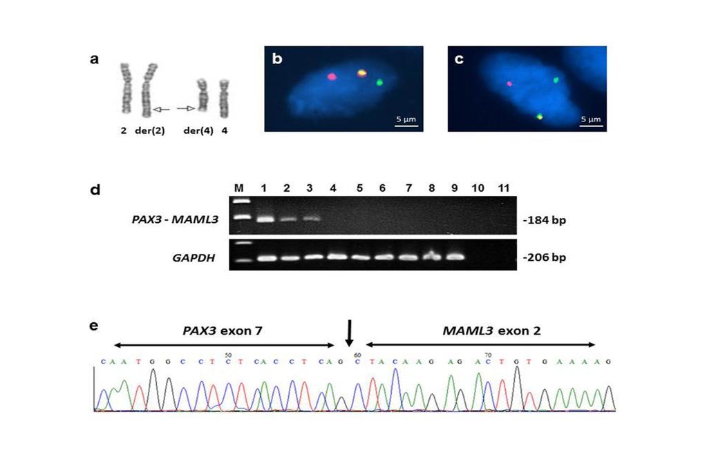 Supplementary Figure 1. Cytogenetics and molecular genetic findings for the PAX3-MAML3 fusion. (a) Partial karyogram showing the chromosomal translocation t(2;4)(q35;q31.1).