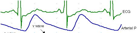 Ανάλυση Πίεσης του δεξιού κόλπου A wave κολπική συστολή C