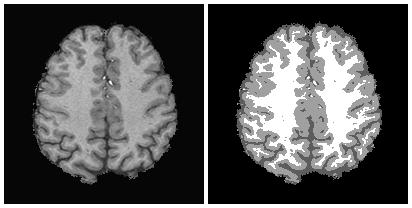 Εικόνα 29: Στην εικόνα τομής με μαγνητικό τομογράφο ενός εγκεφάλου φαίνεται πώς είναι εικόνα εισαγωγής και η αντίστοιχη τμηματοποίησή της.