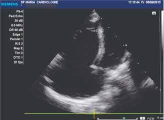 309 drept. Prin Doppler color se poate determina prezenţa şi mărimea şuntului interatrial (Fig. 3). FIGURA 