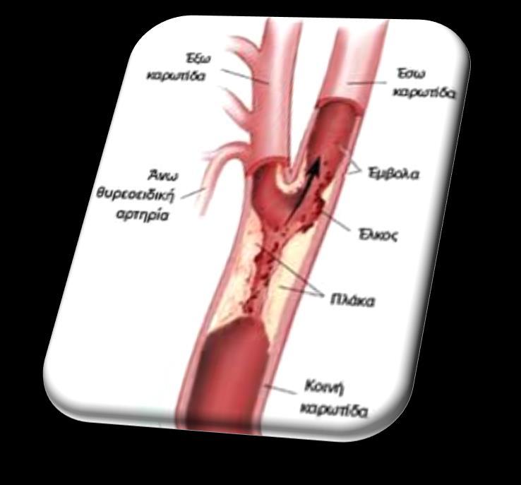 NAFLD - αθηροσκλήρωση Κοινοί παθογενετικοί