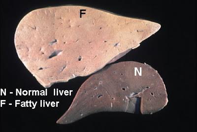 NAFLD-NASH Στεάτωση: εκτιμάται από το % των ηπατοκυττάρων που περιέχουν σταγονίδια λίπους.