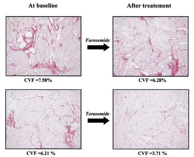 Effects of Loop Diuretics on Myocardial Fibrosis and Collagen Type I Turnover in CHF Pts with NYHA functional class II to IV CHF received either 10-20 mg/day oral torasemide (n =19) or 20 to 40