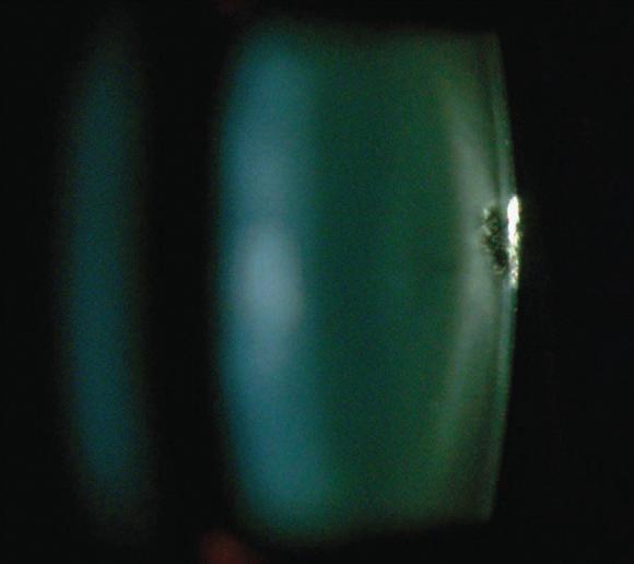 Εμφάνιση καταρράκτη σε επεμβατικούς ιατρούς Subcapsular posterior cataract observed by slit lamp biomicroscopy using direct illumina`on, noted a er 22 years of work in a
