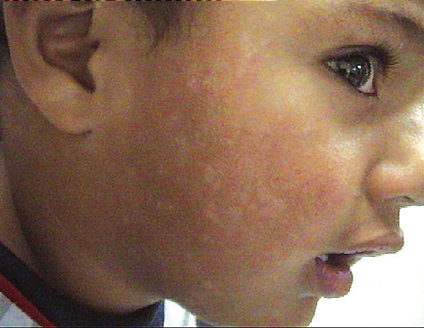 70 4.2 ΨΩΡΊΑΣΗ (PSORIASIS) ΟΡΙΣΜΌΣ Χρόνια φλεγμονώδης, με κληρονομική προδιάθεση για δερματοπάθεια χαρακτηρίζεται από ερυθροϊώδεις, καλώς αφοριζόμενες πλάκες που καλύπτονται από αργυρόχρωα λέπια.