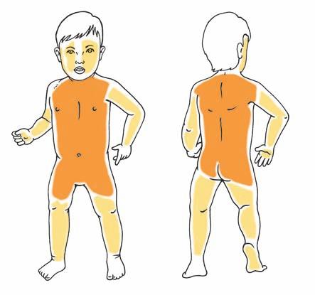 86 4.5 ΛΕΙΧΗΝΟΕΙΔΉΣ ΠΙΤΥΡΊΑΣΗ (PITYRIASIS LICHENOIDES) ΟΡΙΣΜΌΣ Αυτοπεριοριζόμενο, αγνώστου αιτιολογίας εξάνθημα με ευρύτητα κλινικών βλαβών όπως το οξύ βλατιδονεκρωτικό ποικιλόμορφο εξάνθημα (οξεία