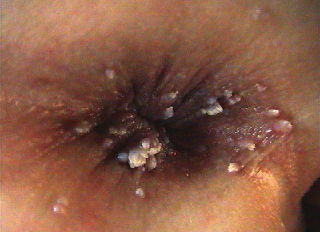 HPV ΛΟΙΜΏΞΕΙΣ 105 Εικόνα 5.4.8 Οξυτενή κονδυλώματα περιπρωκτικά (Συλλογή Α. Κατσαρού).