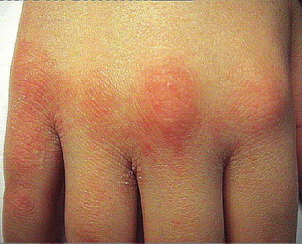 25 3.1 ΕΡΕΘΙΣΤΙΚΉ ΔΕΡΜΑΤΊΤΙΔΑ ΕΞ ΕΠΑΦΉΣ (ΕΔ) (IRRITANT CONTACT DERMATITIS) ΟΡΙΣΜΌΣ Η EΔ είναι η κλινική απάντηση του δέρματος σε μια ποικιλία ερεθιστικών χημικών ουσιών ή φυσικών παραγόντων που