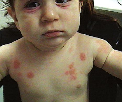 Staphylococcus aureus (χρυσίζοντα σταφυλόκοκκου) Η διαφοροποίηση αυτή του μικροβιώματος στην ατοπική δερματίτιδα συνοδεύεται και από έξαρση της νόσου.