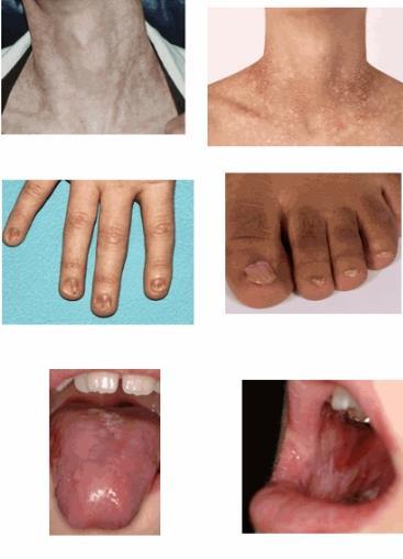 Dyskeratosis Congenita Abnormal skin
