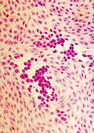 postvirusnog umora coxsackie B Blaga febrilna bolest s osipom ili bez njega