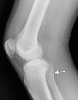 Χρησιμότητα της απλής ακτινογραφίας και της Υπολογιστικής Τομογραφίας. (A, B) Προσθιοπίσθια και πλάγια ακτινογραφία του δεξιού γόνατος.