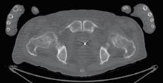 Μέθοδοι Απεικόνισης του Μυοσκελετικού Συστήματος 13 B A Γ Δ Εικόνα 1-9. Εξέταση με NaF PET/CT, όπου απεικονίζονται οστικές μεταστάσεις.