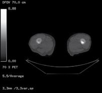 (Β, Γ) Εικόνες Υπολογιστικής Τομογραφίας της πυέλου και του μηριαίου οστού αντίστοιχα, με ετερογενή πυκνότητα του οστικού μυελού στην κατώτερη πύελο (στην Υπολογιστική Τομογραφία οι μεταστάσεις του