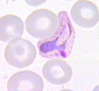 Malarija Klinična slika pri lahkem poteku malarije: nenaden začetek mrlzlice s tresenjem telesa visoka vročina > 40 o C nemir Plasmodium vivax rdeča krvnička okužena s