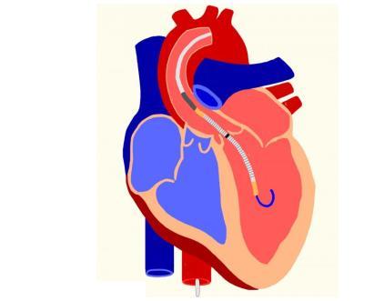 Συνδυασμός Συσκευών Βραχείας και Μακράς Υποβοήθησης σε Καρδιογενή Καταπληξία Discharge