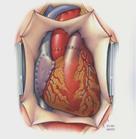 0 LVAD (HM II) ECMO Heart VT -> CPR implantation implantation implantation wean