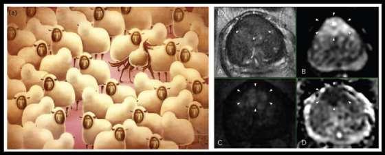 Ενεργός παρακολούθηση και MRI κατάλληλη για διάγνωση καρκίνων εντοπιζόμενων στην πρόσθια ζώνη του προστάτη 2/3 ασθενείς κατάλληλοι για ενεργό παρακολούθηση εμφανίζουν ύποπτη εικόνα MRI 43%: