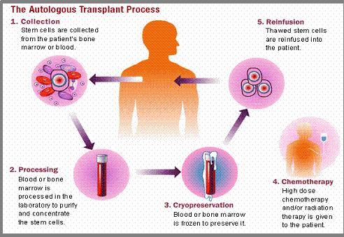 1.Αυτόλογη μεταμόσχευση αιμοποιητικού ιστού Αφαιρεί τους Τ17-βοηθητικούς πληθυσμούς που επάγουν μηχανισμούς αυτοανοσίας και επιτρέπει την επανέκπτυξη παρθένων Τ-βοηθητικών λεμφοκυττάρων High dose