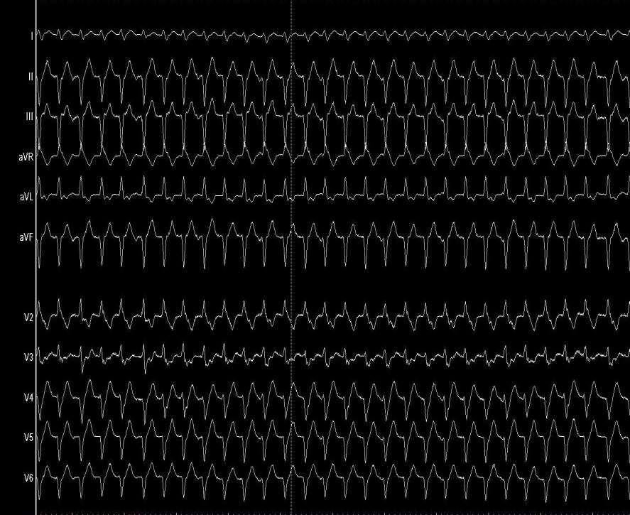 SVT or VT?