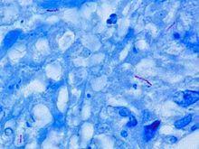 Παλαιότερες μελέτες δείχνουν μία συχνότητα της LA φυματίωσης 3-9