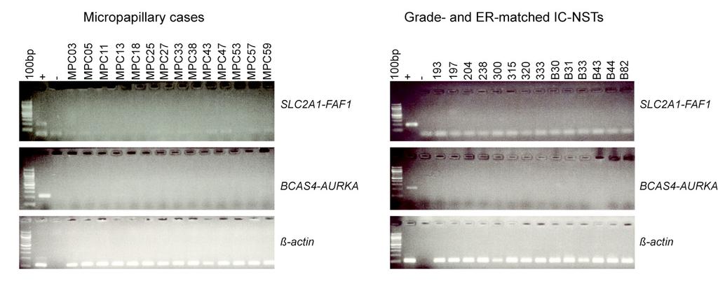 14 Supplementary Figure S4 Supplementary Figure S4. Recurrence RT-PCR screen for nominated fusions in 14 micropapillary and 14 grade- and ER-matched IC-NST.