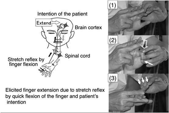 +, PNF,,**3,**3 Fig + Hypothesized mechanism of a newly designed facilitation exercise for the hemiplegic upper limb and fingers Neurons or neural circuits in the motor cortex or descending motor