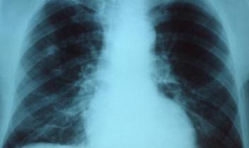 ΟΞΕIΕΣ ΛΟΙΜΩΞΕΙΣ ΚΑΤΩΤΕΡΟΥ ΑΝΑΠΝΕΥΣΤΙΚΟU ΣΥΣΤHΜΑΤΟΣ (Σύντομη ενημέρωση από ERS - ELF) Οι οξείες λοιμώξεις κατώτερου αναπνευστικού συστήματος περιλαμβάνουν την πνευμονία (λοίμωξη της κυψελίδας του