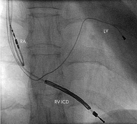 Τύποι ICD Single chamber