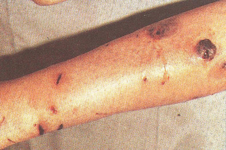 P. multocida