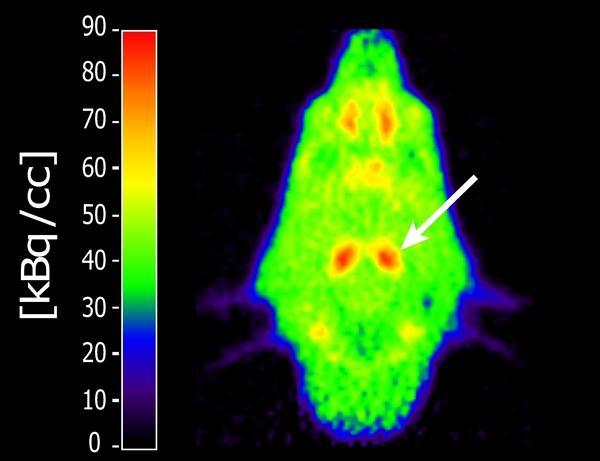 o o o Za PET/CT se najčešće koristi analog glukoze, fluorodeoksiglukoza (FDG), obeležena ciklotronskim proizvodom, izotopom fluora (18F), koji se inicira intravenski, te ulaskom u ćelije pokazuje