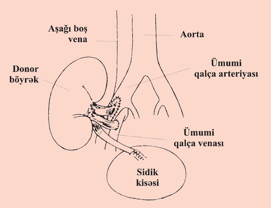 Dializ entin bədəninə qoyulmsı böyrəkköçürmə adlanır.