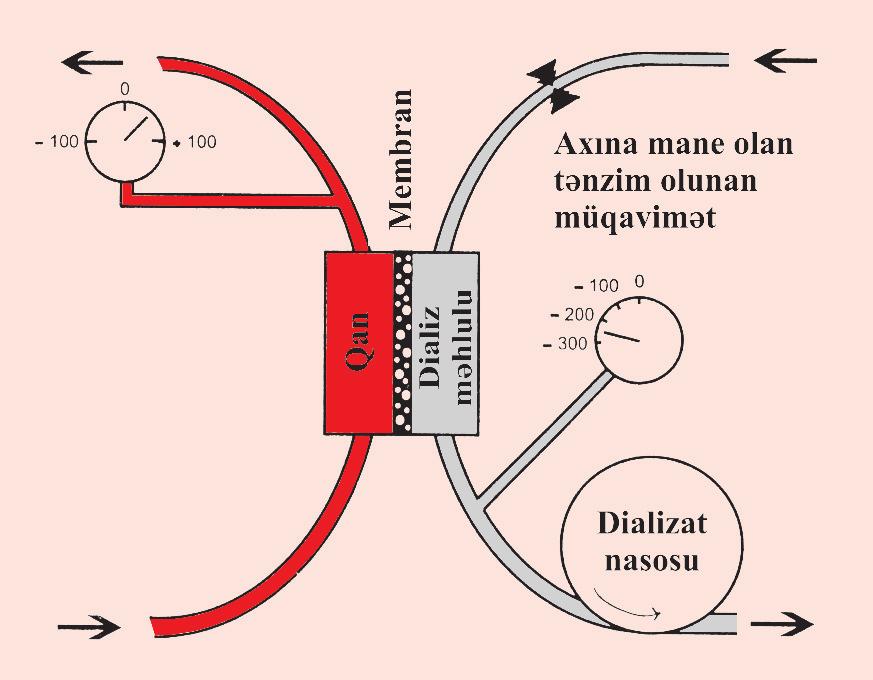 Dializ Zülal ilə birləşmiş maddələr HD ilə kənar edilə bilmir, ona görə bu məqsədlə hemosorbsiya (qanın kömür kolonkalardan keçirilməsi) plazmaferez aparılır.