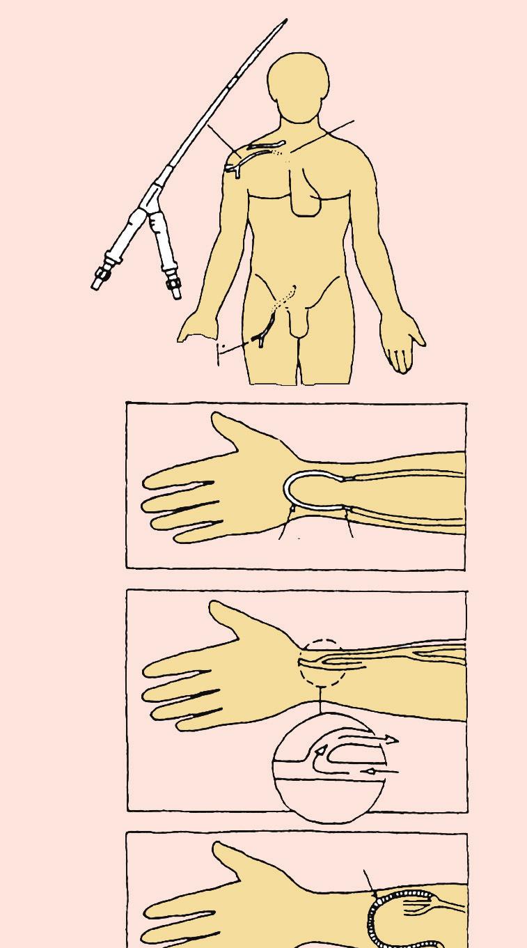 Dializ êþðïöúöêàëòû Êàòåòð áóä Øóíò