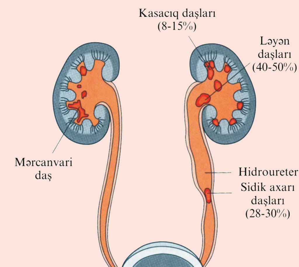 Dializ * sidik kisəsinin innervasiyasının pozulması, onurğa beyninin zədələnməsi, diabetik neyropatiya; * sidik kanalının daralması.
