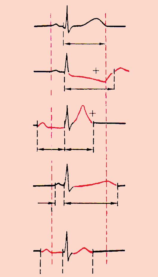 Fəsil 2. XBÇ-nin etiopatogenezi, klinikası aldosteron təsirinin inhibisiyası; K ionunun tubular sekresiyasının pozulması; duzitirən nefropatiya; YFS 15 ml/dəq çox azalması (terminal XBÇ).