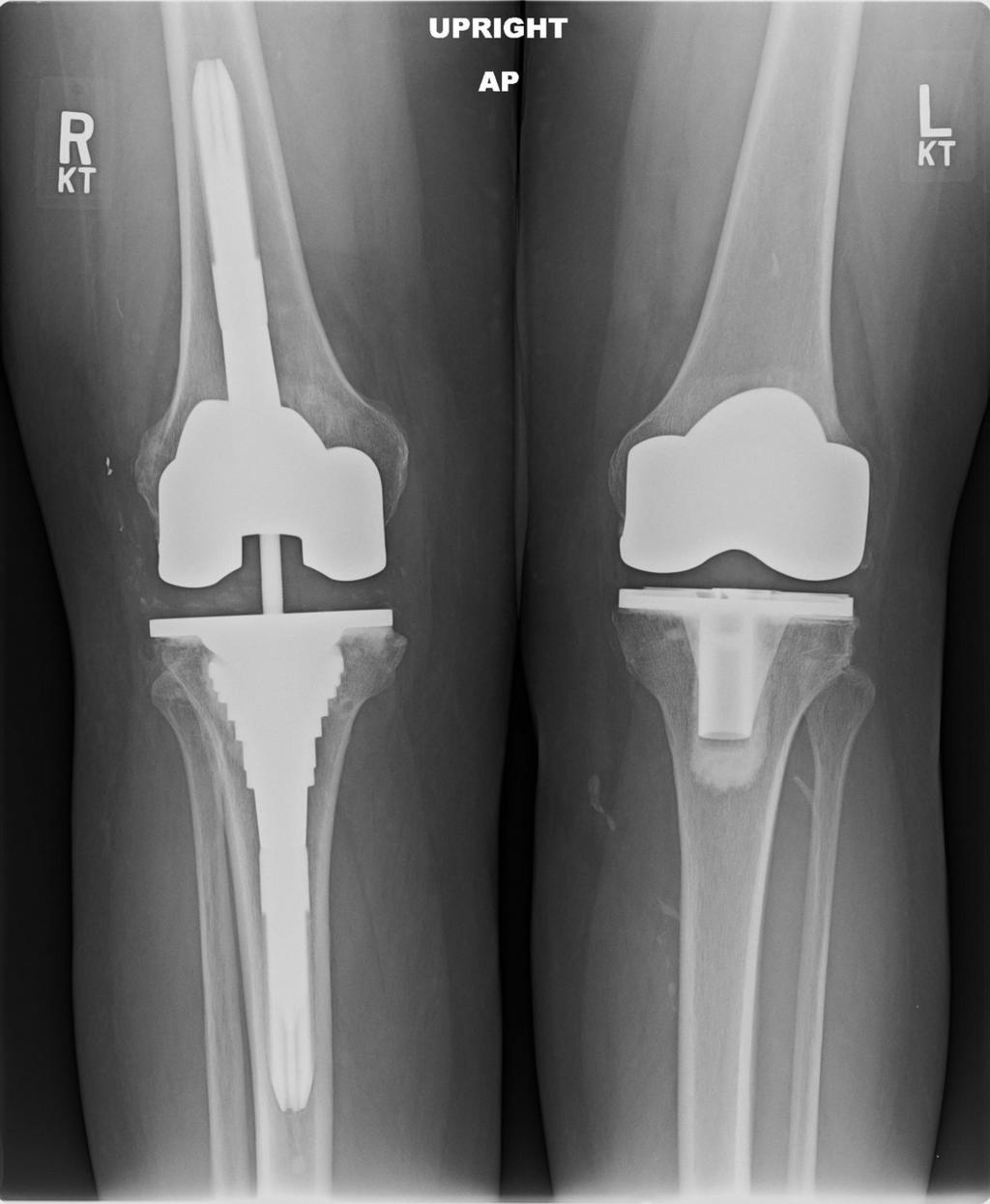 Η αρθρόδεση στην αρθρίτιδας τοy γόνατος μόνο ως λύση απελπισίας θα πρέπει να εφαρμόζεται.