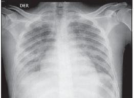 Diagnostikoa Gorozkietan larbak ikusi