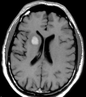 sintomak: eztula eta disnea Sintoma neurologikoak: zefalea, lepo zurruntasuna Azal lesioak