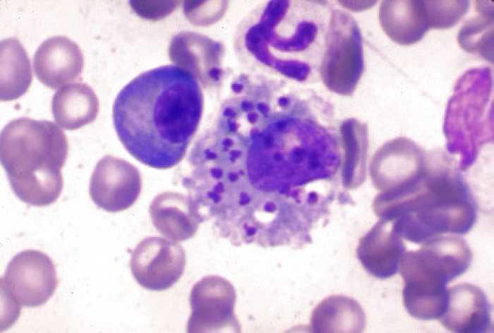AMERIKA ERDIKO GAIXOTASUN INFEKZIOSO INPORTATUAK LEISHMANIASIA Leishmania donovani eta L.