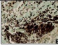 HISTOPLASMOSIA GIB+ PAZIENTEETAN DIAGNOSTIKOA - Gongoil linfatikoak