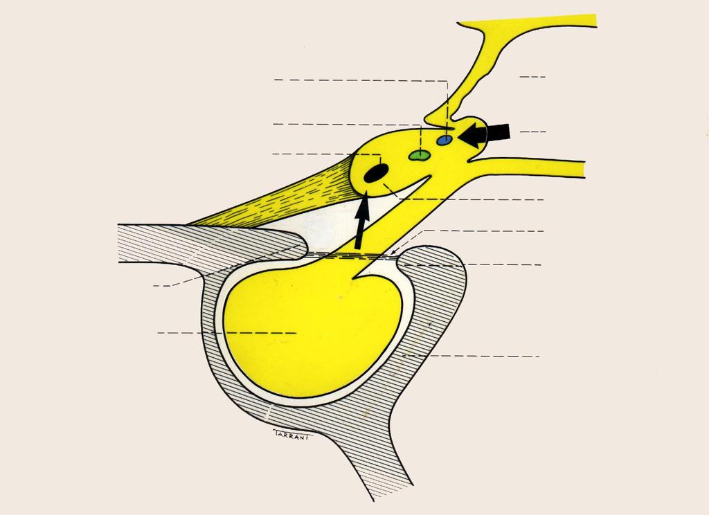 Anatomy of chiasm and pituitary gland Upper nasal fibres III rd ventricle Macular fibres Lower nasal fibres