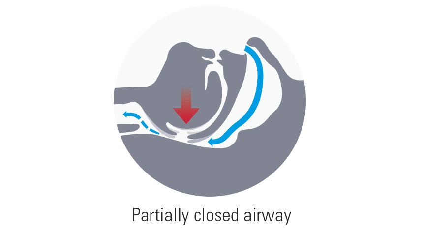 Obstructive Sleep Apnea (OSA): η αποφρακτική άπνοια ύπνου είναι ο πιο συνηθισμένος τύπος άπνοιας στον ύπνο, που αποτελεί το 84% της διάγνωσης της άπνοιας κατά τον ύπνο.