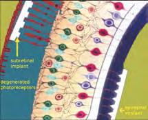 תמונה 3: מיקומו של שתל תת-רשתי באיור וכפי שנראה מתחת לפני הרשתית בצילום צבע תמונה 1: מיקום השתלים העל-רשתיים בין הזגוגית ושבכת ה- membrane Internal limiting ומיקום השתלים התת-רשתיים בין הרשתית