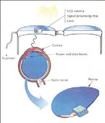 microphotoiodes כאשר סיגנל האור פוגע בהן, הן מתורגמות לסיגנל חשמלי המועבר לרשתית הנוירוסנסורית תמונה 5: שתל המגרה את עצב הראייה: בשיטה זו מושתלות אלקטרודות סביב עצב הראייה, והן מגורות על ידי מקור מתח