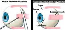 בניתוחי תיקון פזילה משתמשים באופן עקרוני בטכניקות שונות כאשר המטרה להביא למרכז את העין הסוטה ממקומה על ידי ניתוח בעין אחת או שתי עיניים. העיקרון הוא להרפות שריר מתוח או לחזק שריר רפה.