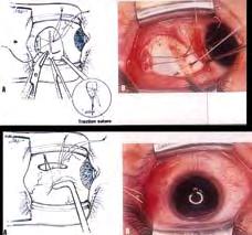 טכניקת החלשת שריר Recession חיזוק שריר, - Resection על ידי חיתוך חלק מהשריר וחיבורו מחדש למקום חיבורו לגלגל העין, השריר נמתח ומתחזק )תמונה 6(. חידושים בניתוחי פזילה בשלושת העשורים האחרונים א.