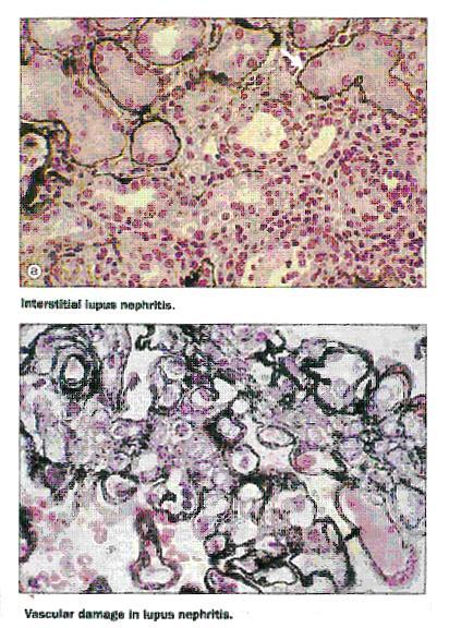 Lupus nephritis