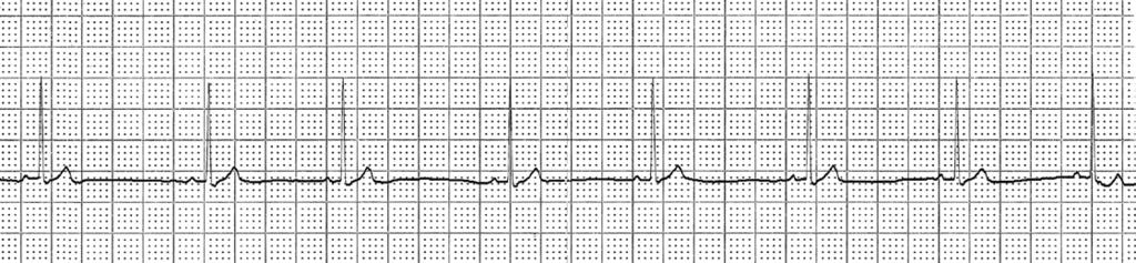 5 (b) ΗΚΓ από γάτα μετά από ηρέμιση, όπου απεικονίζεται φλεβοκομβική βραδυκαρδία με συχνότητα καρδιακών παλμών 110 παλμούς/min (25 mm/sec και 10 mm/mv).